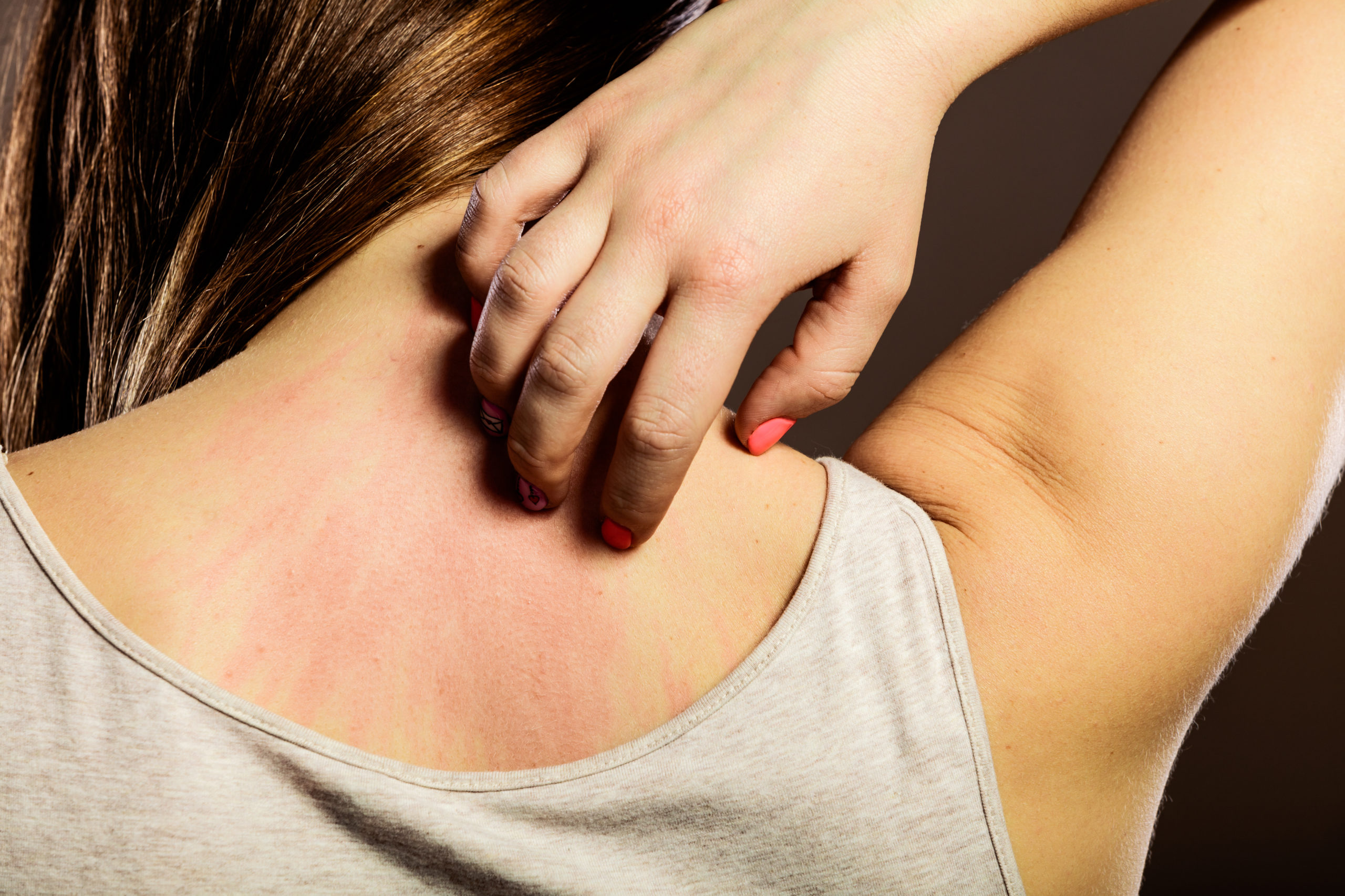 Skin Rash: Types of Rash,Symptoms & Cause