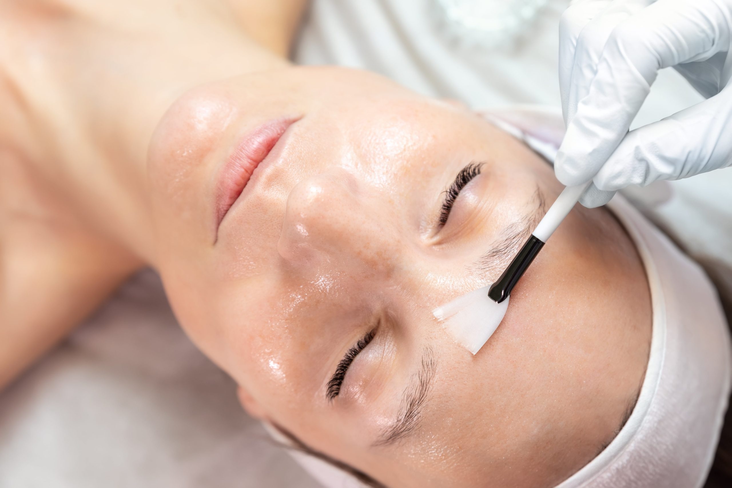 What are the Types of Chemical Peels