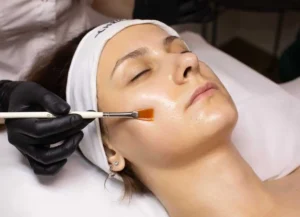 Chemical Peels Treatment for Sun Damage by Ella Medical Aesthetics in Austin, Texas